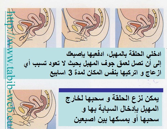 طبيب الوب - طرق منع الحمل الهرمونية. 